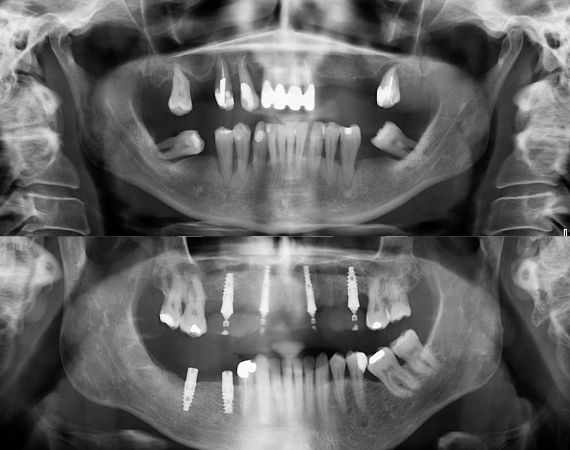 Antes y después implante
