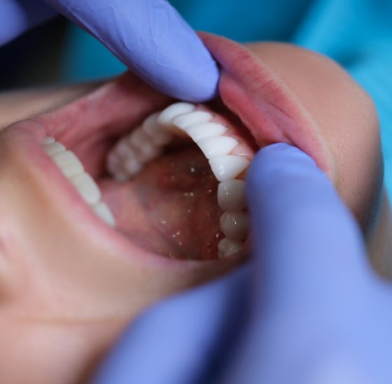 Tratamiento periodoncia Innovación Dental Manzanares