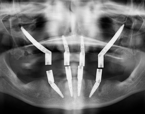 Implante Zigomático